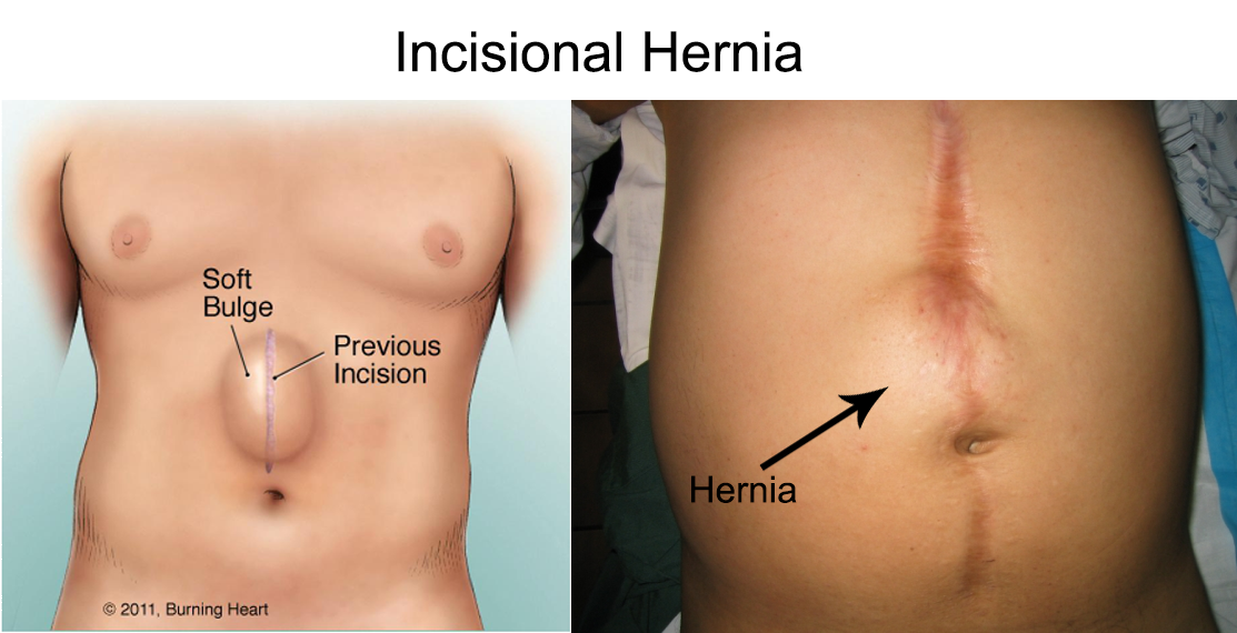 Best Incisional Hernia Surgeon in Delhi NCR